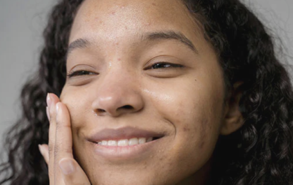 causes of adult acne and how to treat it